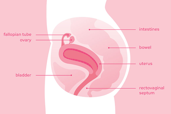 Endometriosis lesions are most commonly found on organs in the pelvic area.